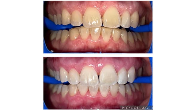 Image Dentalhygiene&Bleaching